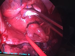 Cirugia cardiaca intervención FA aislada por minitoracotomia